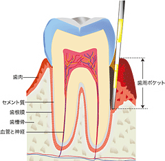 歯周ポケットの測定